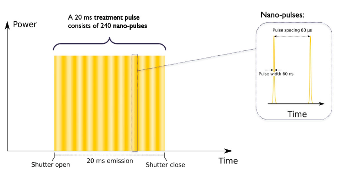 ADVATx laser - PulSync pulse