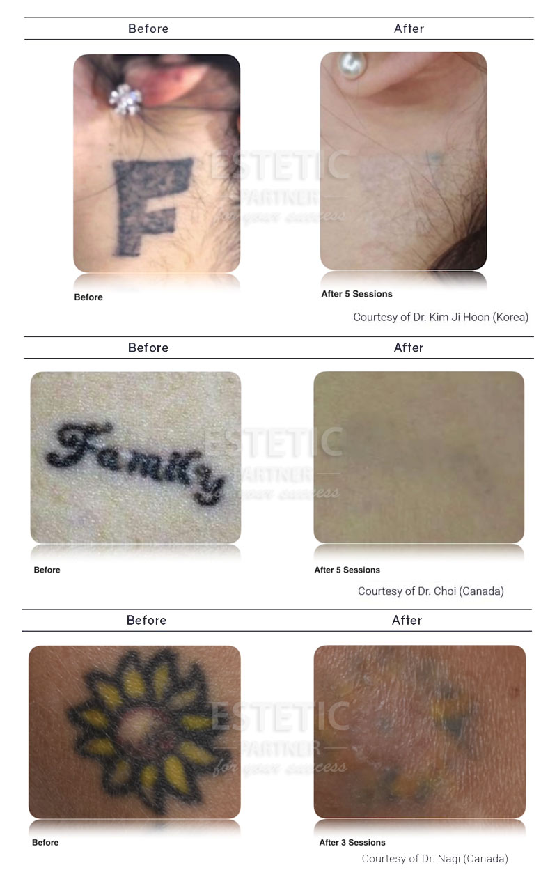 PicoLO tattoo removal - before-after