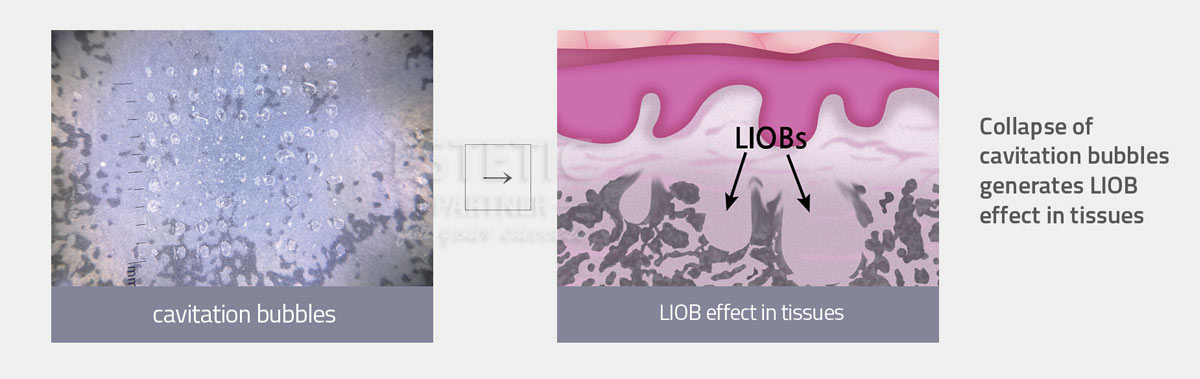 PicoLO LIOB effect